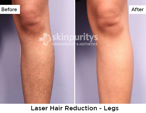 Laser Hair Reduction results